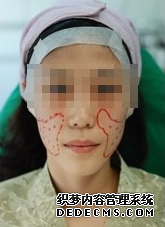 【真人案例】填充脂肪就像做脸部按摩一样,看下我的感受吧