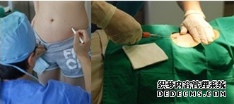 【真人案例】填充脂肪就像做脸部按摩一样,看下我的感受吧